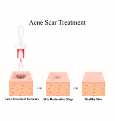 Acne Scars Laser Scar Atrophic Treatment