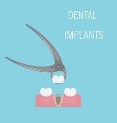 Dental Implant Installation Aesthetic Dentistry