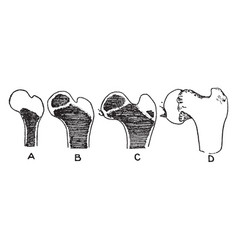 Ossification Of The Femur And The Condition