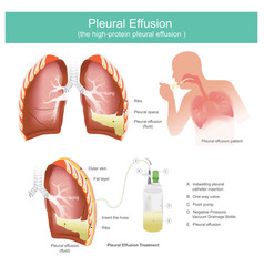 Tuberculosis Tb Infection In Lungs Patients