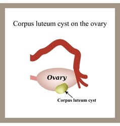 Corpus Luteum Cyst On The Ovary Functional Cyst