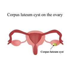 Corpus Luteum Cyst On The Ovary Functional Cyst