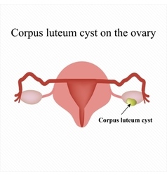 Corpus Luteum Cyst On The Ovary Functional Cyst