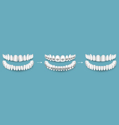 Dental Braces Before And After Result