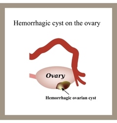 Hemorrhagic Cyst On The Ovary Ovary Infographics