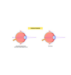 Normal Eye And Farsightedness