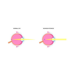 Normal Eye And Nearsightedness