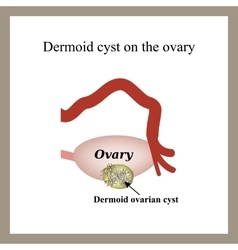 Dermoid Cyst On The Ovary Ovary Infographics