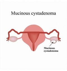 Mucinous Cyst On The Ovary Cystadenoma Ovary