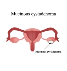 Mucinous Cyst On The Ovary Cystadenoma Ovary