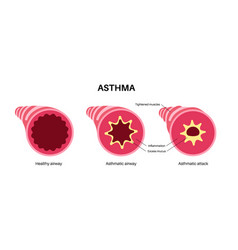 Asthma Lung Disease