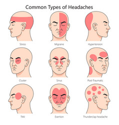 Common Types Of Headache Structure Diagram Medical