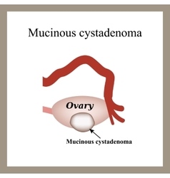 Mucinous Cyst On The Ovary Cystadenoma Ovary