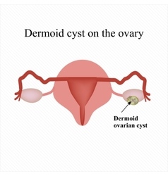 Dermoid Cyst On The Ovary Ovary Infographics