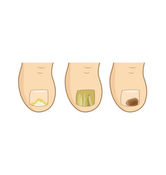 Toenail Mycosis Types