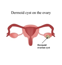 Dermoid Cyst On The Ovary Ovary Infographics