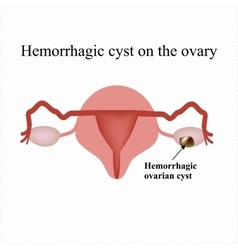 Hemorrhagic Cyst On The Ovary Ovary Infographics