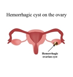 Hemorrhagic Cyst On The Ovary Ovary Infographics