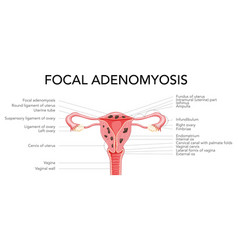 Adenomyosis Focal With Inscriptions Human Anatomy