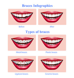 Teeth Braces Types Realistic Infographics