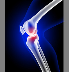 X-ray Of Leg And Knee Bone Showing Pain