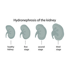 Renal Hydronephrosis Is A Progressivestages