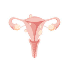 Female Uterus With Different Types Of Fibroids