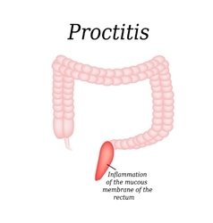 Colon Proctitis On Isolated