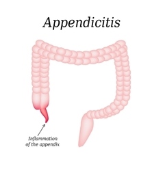 Appendicitis inflammation of the appendix colon Vector Image