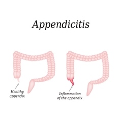 Appendicitis inflammation of the appendix colon Vector Image