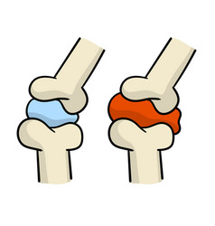 Arthritis Disease Of Joints Biology And Anatomy