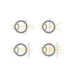 Medical Of Vision And Refractive Error Normal