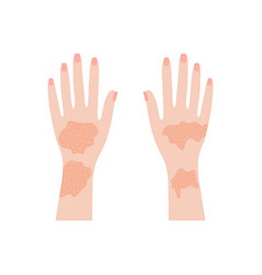 Human Hands With Psoriasis And Rashes