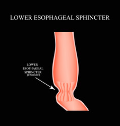 Lower Cardiac Esophageal Sphincter Infographics