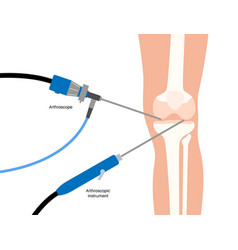 Knee Joint Arthroscopy