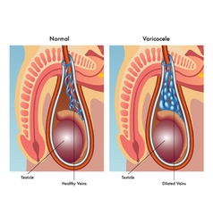 Varicocele