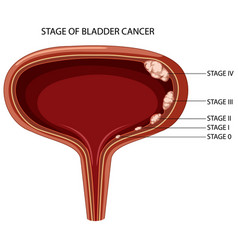 Stage Of Bladder Cancer