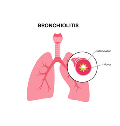 Bronchiolitis Lung Disease