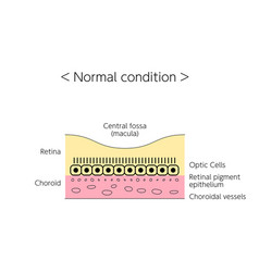 Eye Disease Of Age-related Macular Degeneration