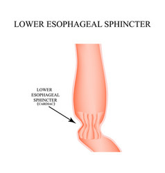 Lower Cardiac Esophageal Sphincter Infographics