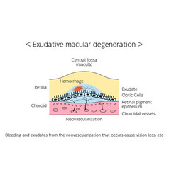 Eye Disease Exudative Age-related Macular