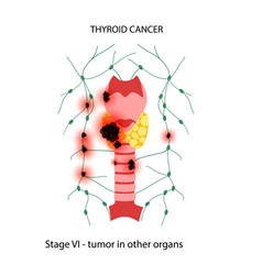 Thyroid Cancer Stages