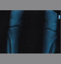 Knee X-ray Realistic Scan