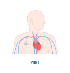 Implantable Venous Access Port On Male Body