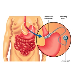 Adjustable Gastric Banding