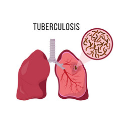 Human Lungs Infected Mycobacterium Tuberculosis