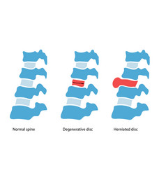 Intervertebral Hernia Concept