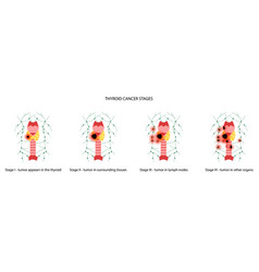 Thyroid Cancer Stages