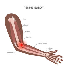 Lateral Epicondylitis Tennis Elbow