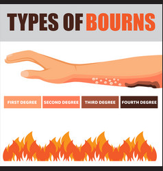 Skin Burn Injury Treatment And Stages Infographic